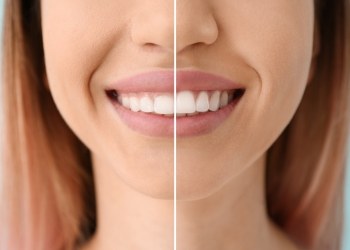 Close up of woman smiling before and after gummy smile correction