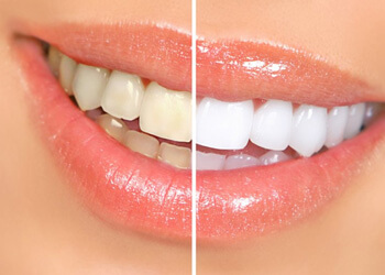 before and after teeth whitening