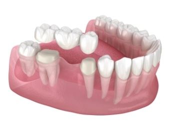 Illustrated dental bridge being placed onto two natural teeth to fill the space between them