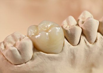 computer model of a crown being placed over a tooth