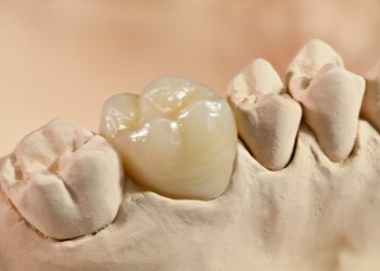 Dental crown covering a tooth in a model of the mouth
