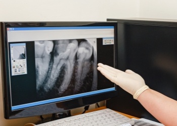 Gloved hand gesturing to a computer monitor showing digital x rays of teeth