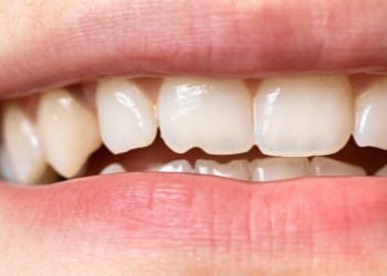 Close up of mouth with a few chipped teeth