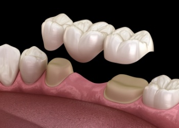 Illustrated dental bridge being fitted over two natural teeth