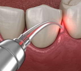 Illustrated dental laser treating gums