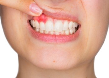 Close up of person pointing to red spot in their gums