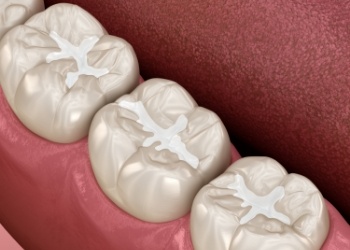 Illustrated row of teeth with dental sealants