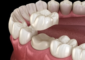 Illustrated dental crown covering a tooth