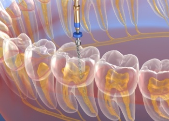 Illustrated dental instrument treating the inside of a tooth