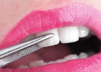 Close up of a veneer being placed over a tooth