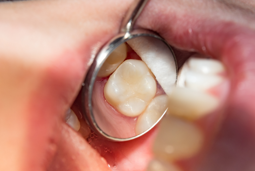 Close up of molar with filling